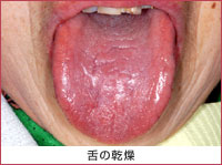 写真：舌の乾燥