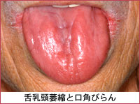 写真：舌乳頭萎縮と口角びらん