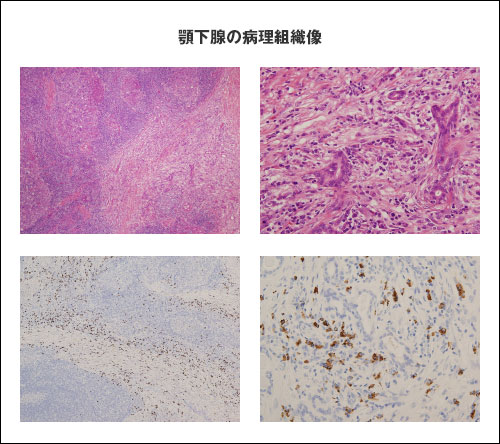 �{���B�̕a���g�D��