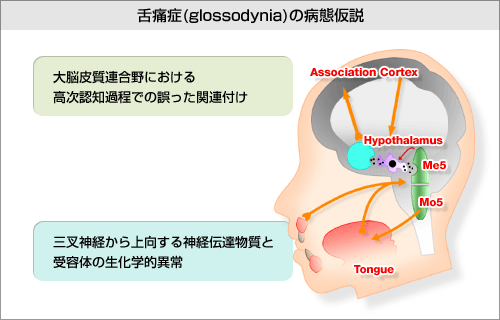 ��ɏ�(glossodynia)�̕a�ԉ����̐}