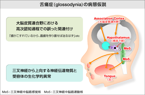 ��ɏ�(glossodynia)�̕a�ԉ����̐}
