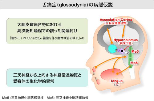 舌痛症(glossodynia)の病態仮説の図